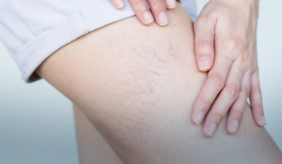 Så kan du få hjälp för venerna